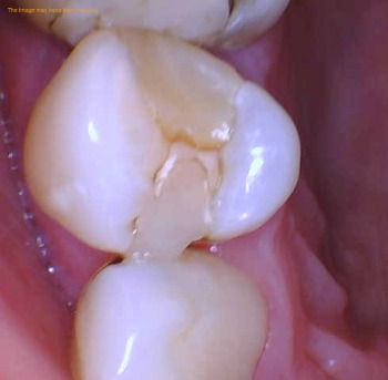 Old defective filling