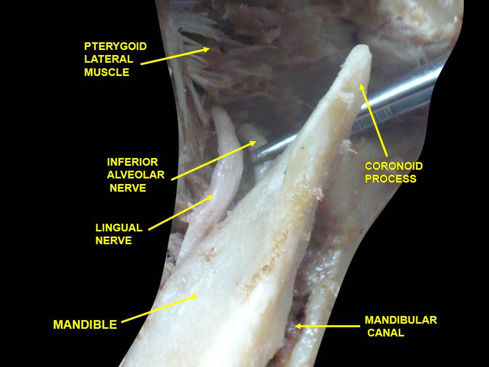 Mandibular nerve dissected view