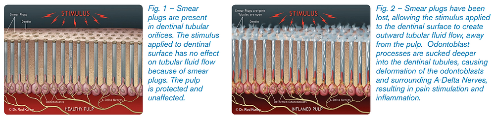 Smear Plugs