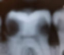 large cavities in between the teeth on molars