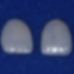 Feldspathic-Veneers