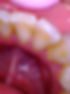 Mild tartar build up