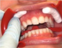 Step 1 placing the cheek retractors