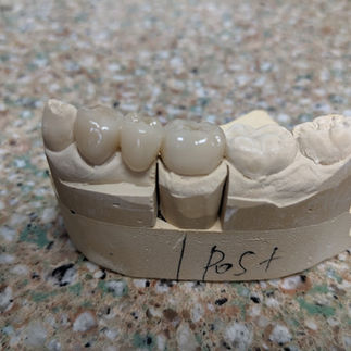 tooth bridge on model