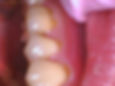 Gum recession showing exposed root surfaces
