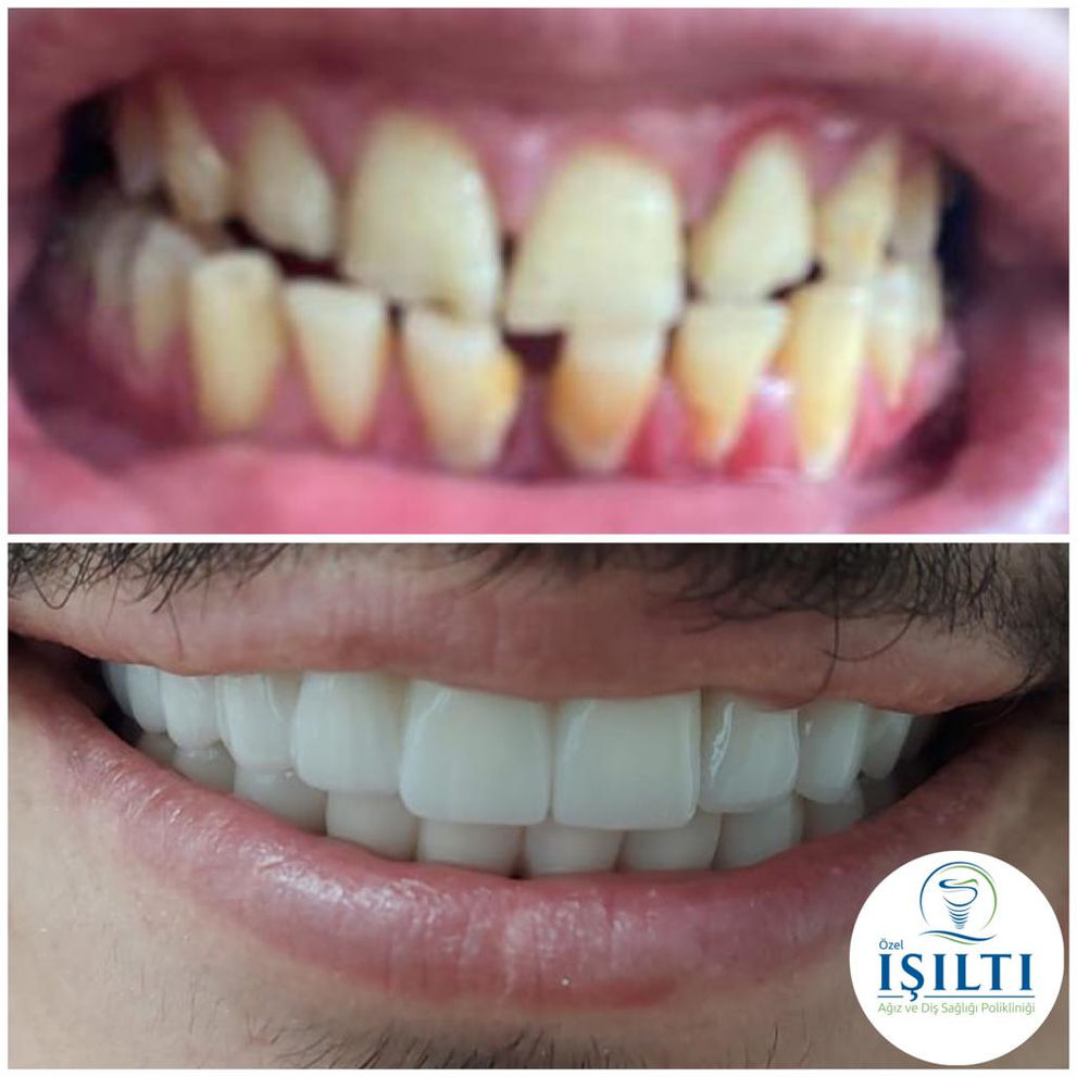 zirconia before after.jpeg