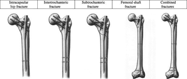 Post Operative Palliative care for an ORIF and Intra-medullary metallic nail implantation case.