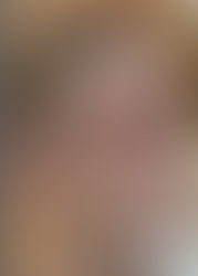 Mid Face Anatomy with Lamija Hubjer, PA-C