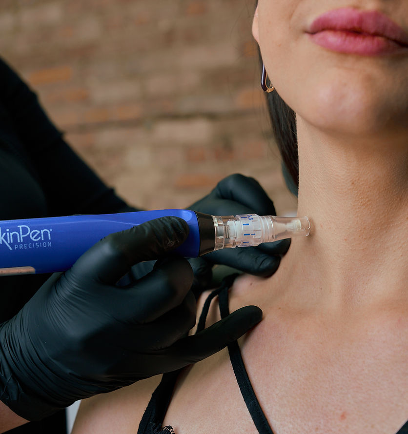 MICRONEEDLING REGENERATIVE PACKAGE