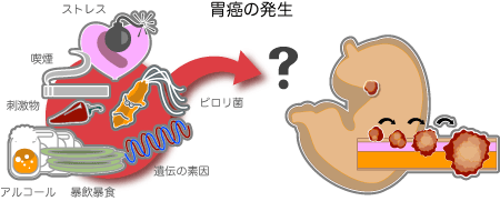 日本胃癌治疗排名第一的医院是如何治疗胃癌的？