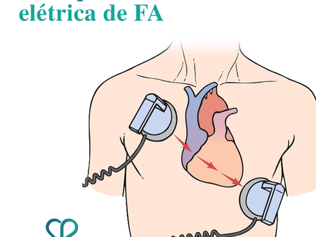 Guia para cardioversão elétrica de FA