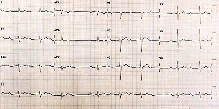 Bradiarritmia