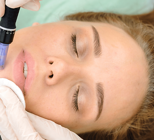 microneedling+blog.png