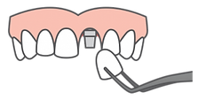 single-tooth-replacement-img-300x151.png
