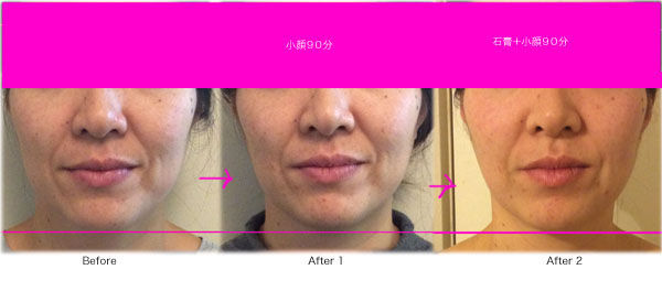 小顔90分