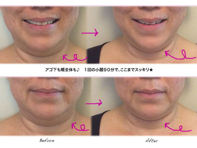 小顔90分