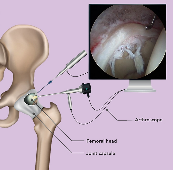 Medical illustration showing hip arthroscopy used to visualize and treat structures inside the hip joint