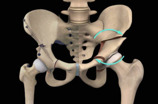 Combined Hip Arthroscopy & Periacetabular Osteotomy (PAO)Surgery: Patient Education