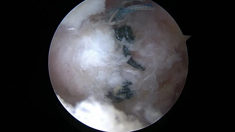 Arthroscopic view of capsular plication showing sutures tightening the hip joint capsule to treat instability