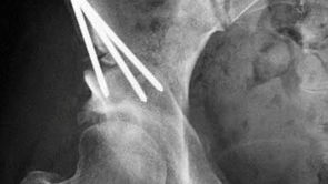 PAO Surgery Screws: Permanent vs. Temporary – What You Need to Know