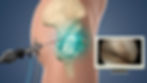 Robotic surgical tool performing hip arthroscopy on model hip joint. Screen shows internal view. Blue background, clinical setting.