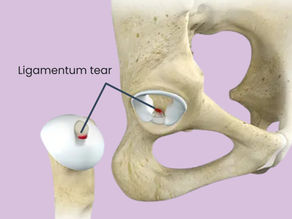 Understanding the Ligamentum Teres: Function, Injuries, and Treatment Options