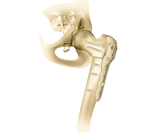 Illustration of Derotational Femoral Osteotomy (DRFO) correcting an abnormal femoral rotation