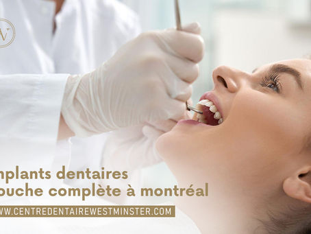 Choisissez les meilleurs implants dentaires bouche complète à Montréal