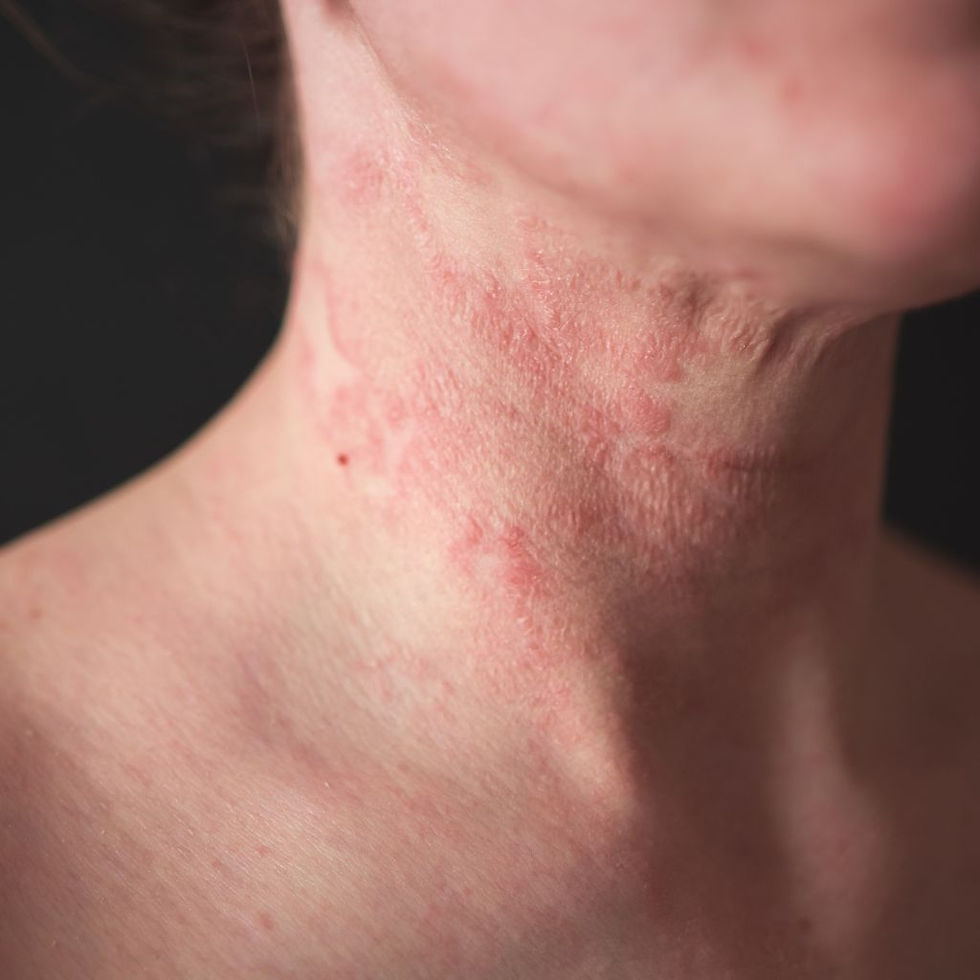 Dermatitis