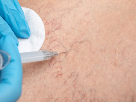 Über Besenreiser: Effektive Behandlungsmethoden wie Verödung & Laser, sowie Tipps zur Vorbeugung. Für gesunde und schöne Beine!
