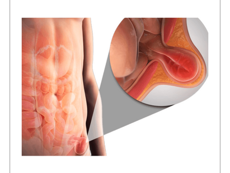Uso de Toxina BotulÃnica en la Pared Abdominal