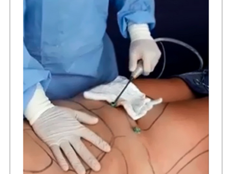 TecnologÃa Heus: Cómo Transformar la Lipo HD en Resultados Impresionantes