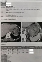 CT画像
胃がん
進行胃がん
末期がん
癌
アラビノキシラン
オリザロース
superAFTM