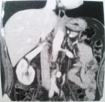 CT画像
CT
検査
胃がん
進行胃がん
アラビノキシラン
オリザロース
発酵古代米