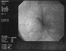 胃カメラ
胃内視鏡
検査
造影剤
胃がん
進行胃がん
末期がん