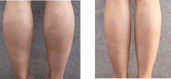図1botox4.png