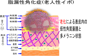 Kclinic 脂漏性角化症 老人性イボ 断層-1-e1499663131286