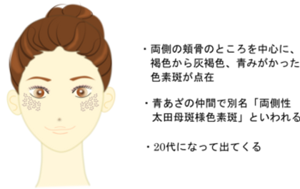 K-clinic-真皮メラノーシス-描画-e1499643404815.png