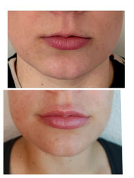 Huulten täyttö, Aliaxin Fl 0,5ml + Aliaxin LV 0.5ml