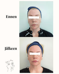 Aliaxin täyteainehoidot Kangasala