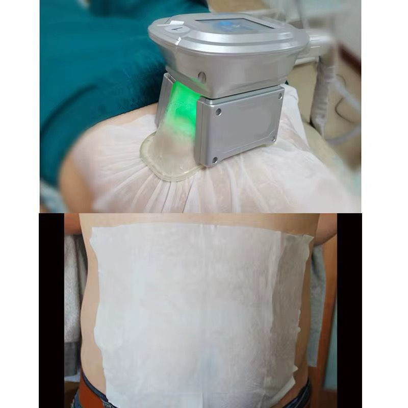 Thumbnail: Fat Freezing Membrane