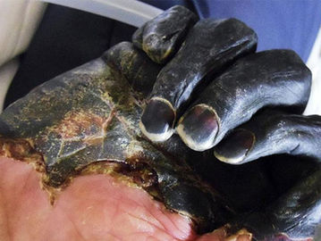 Bagian tubuh yang menghitam ketika terkena pes membuat penyakit ini disebut Black Death pada abad ke-14 di Eropa.