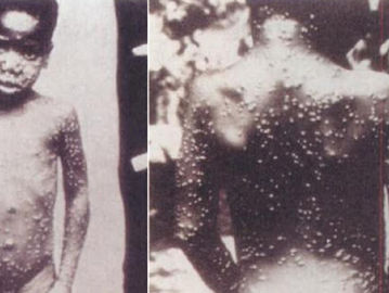 Cacar monyet yang diderita anak perempuan di Zaire. (Repro Zoonosis/Virology).
