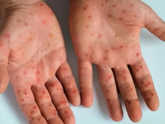 Goianésia registra caso suspeito de Mpox em 2026; Goiás soma 15 notificações no ano