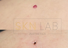 Cherry angioma removal ware