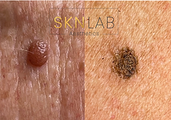 skin tag removal ware