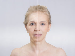 Liquid Facelift with Botox & Juvederm  
