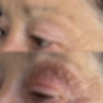 Plasma Non-surgical blepharoplasty