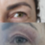Plasma Non-surgical blepharoplasty Upper