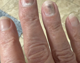 Trapped Fingers